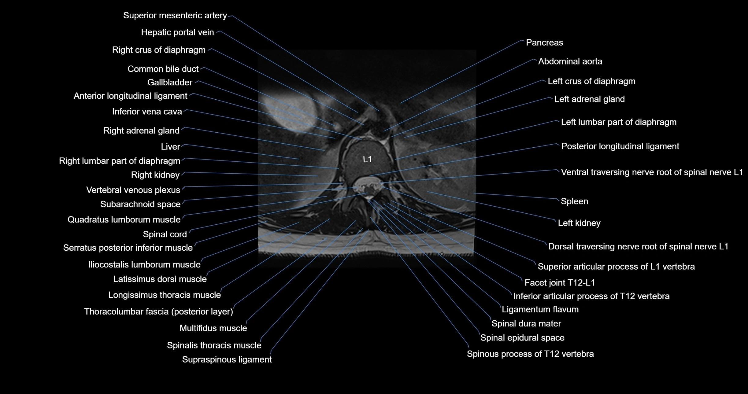 MRI lumbar spine axial cross sectional anatomy 3T radiology  image-img-00001-00006.webp